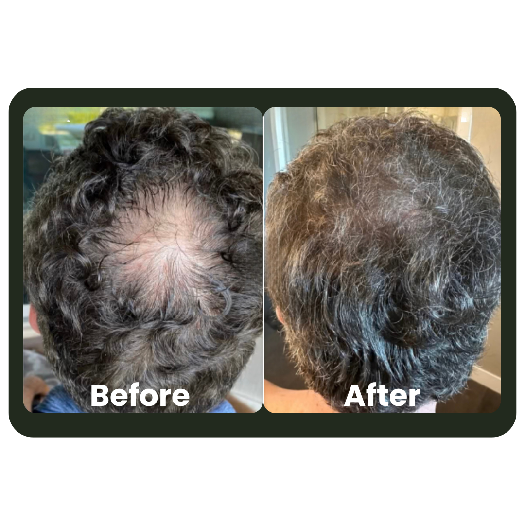 Cleava ™ Hair Growth Roll-On Serum